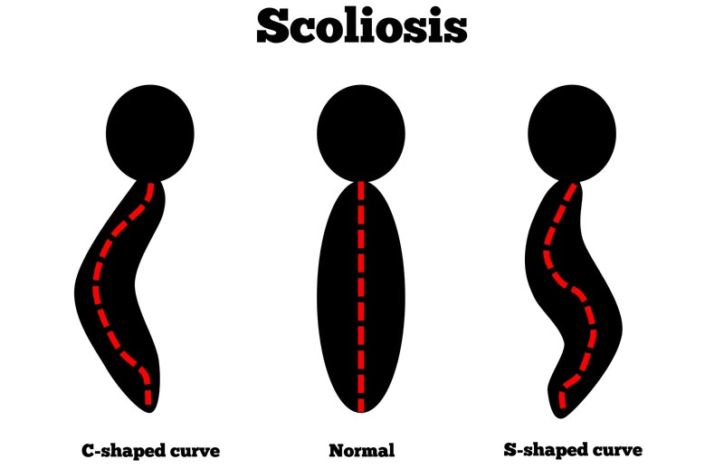 Washington, NC scoliosis treatment