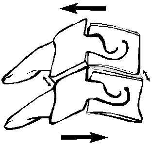 Low back pain from whiplash