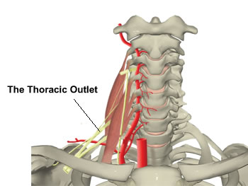 Thoracic Outlet Syndrome